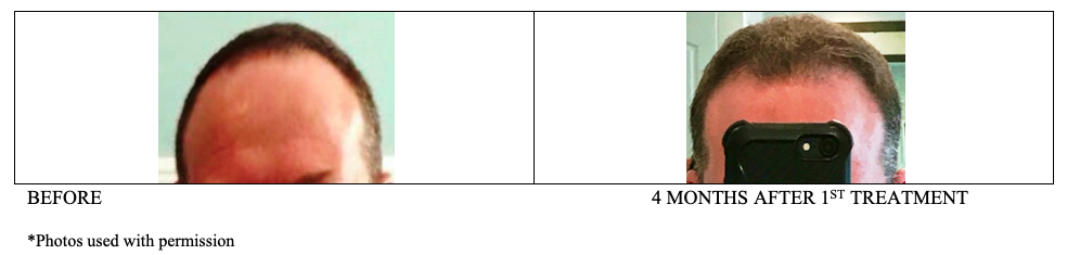 Before/After PRP Hair Rejuvenation